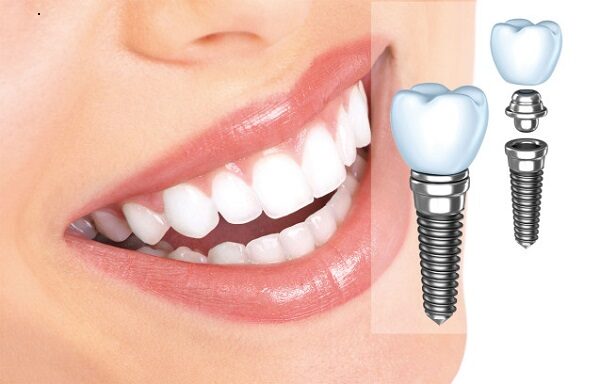 Trồng răng implant cần thơ