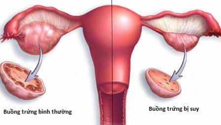 So sánh chất lượng buồng trứng bình thường và suy