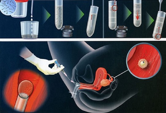 Các phương pháp hỗ trợ sinh sản cho nữ PCOS