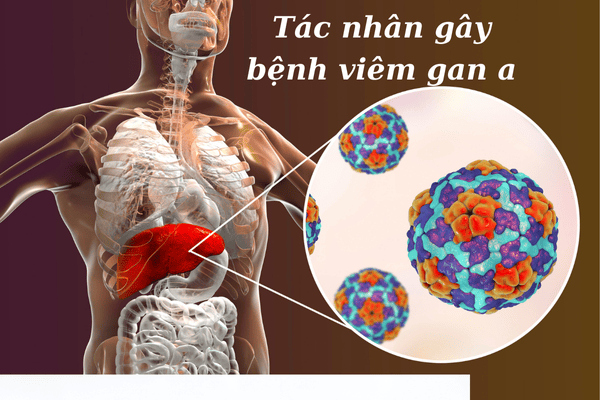 Tác nhân gây bệnh viêm gan A và những điều cần biết