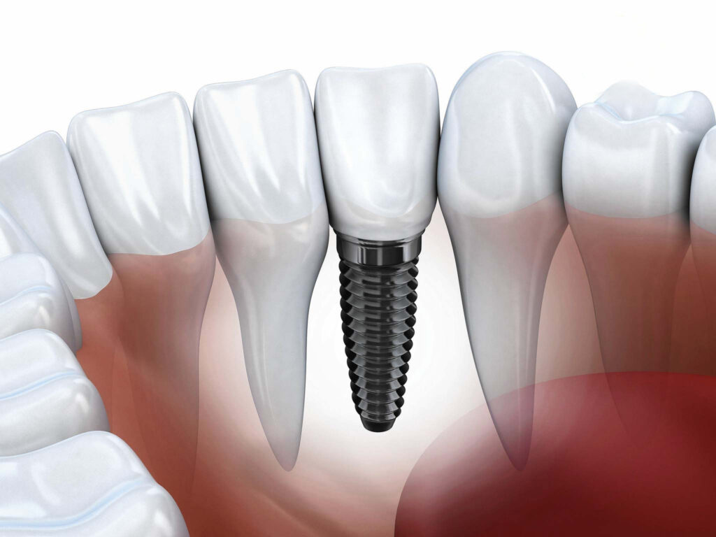 Ghép xương răng để cấy Implant có đau không?