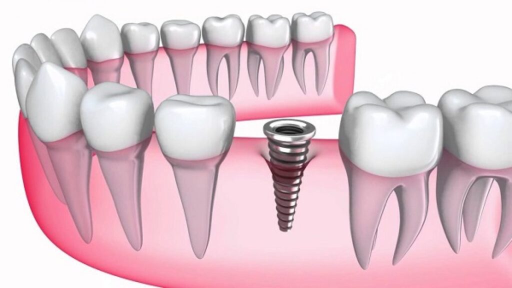 Titanium tương thích với xương rất tốt