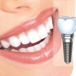 Trồng răng Implant thẩm mỹ