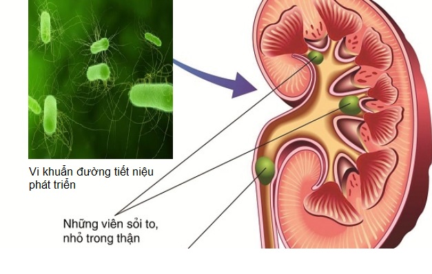 Dấu hiệu nhận biết nhiễm trùng đường tiết niệu