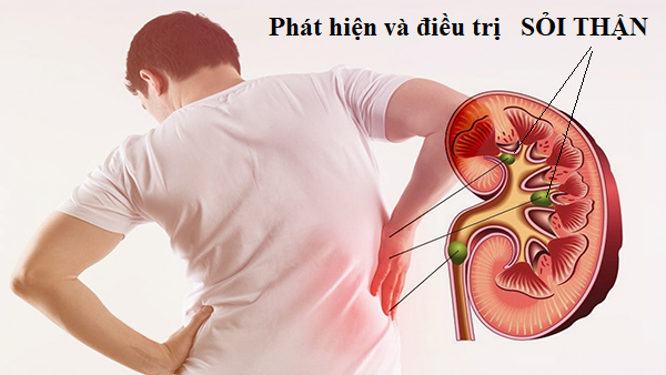 Triệu chứng sỏi dường tiết niệu