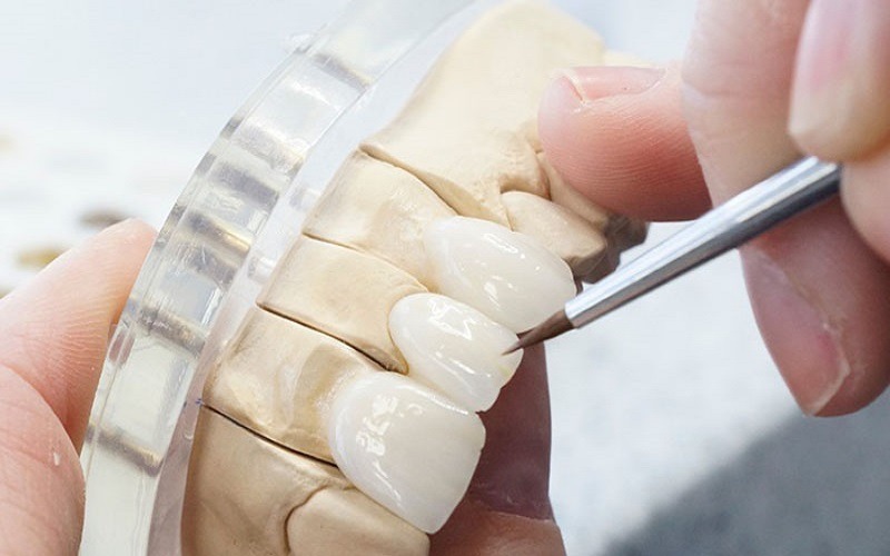 Lithium Disilicate (IPS e.max) - Thẩm mỹ cao cho răng cửa