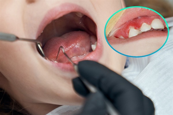 Nguyên nhân sưng nướu răng thường gặp