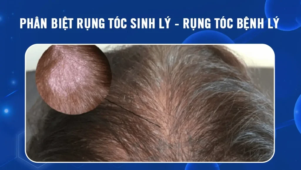 Phân biệt rụng tóc sinh lý và rụng tóc bệnh lý