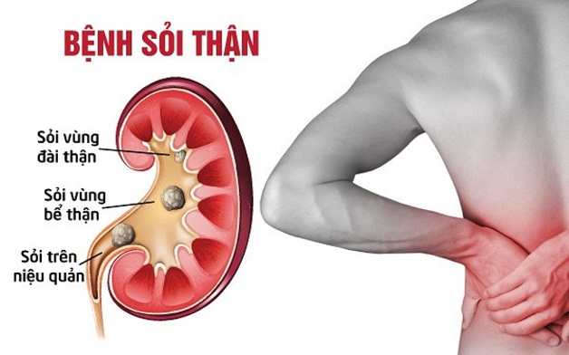 Sỏi thận là gì