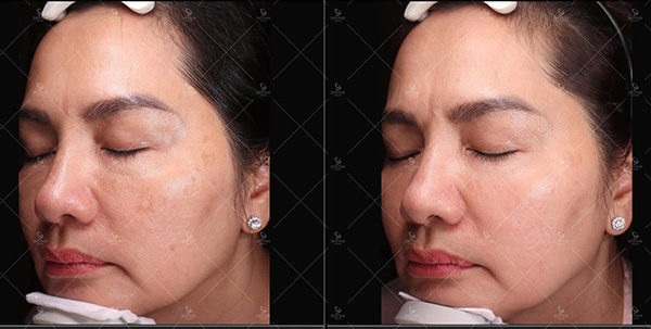 Đối tượng phù hợp với phương pháp laser trị nám