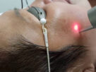 Ai nên trị nám bằng laser và trường hợp nào cần cân nhắc