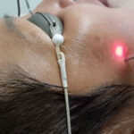 Ai nên trị nám bằng laser và trường hợp nào cần cân nhắc