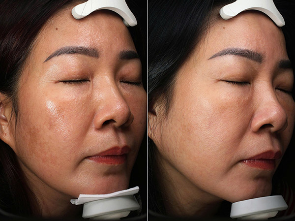 Bác sĩ tư vấn người nên điều trị nám laser