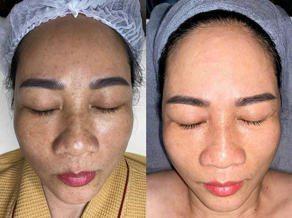 Những trường hợp có thể cân nhắc laser nám