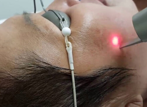 Ai nên trị nám bằng laser và trường hợp nào cần cân nhắc