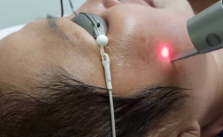 Ai nên trị nám bằng laser và trường hợp nào cần cân nhắc