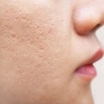 Các phương pháp điều trị sẹo rỗ đáy nhọn phổ biến