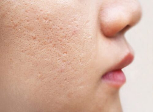 Các phương pháp điều trị sẹo rỗ đáy nhọn phổ biến