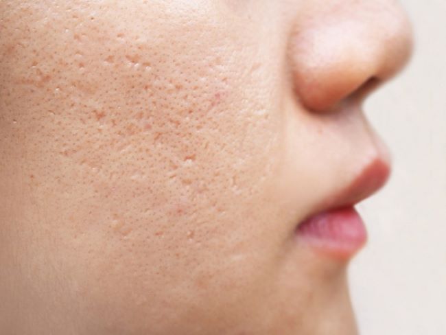 Các phương pháp điều trị sẹo rỗ đáy nhọn phổ biến