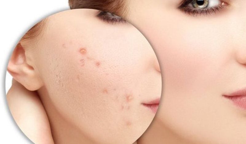 Hướng dẫn kiêng cữ khi điều trị sẹo