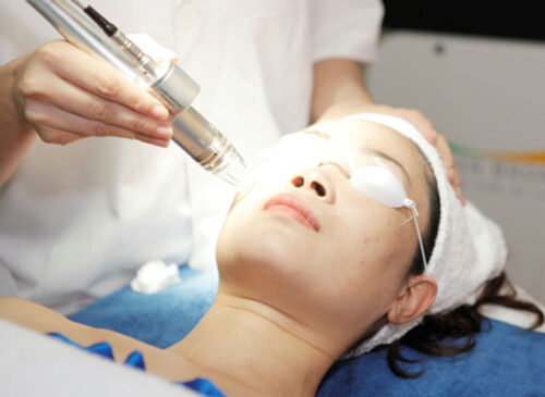 Laser trị sẹo rỗ bị thâm do đâu và cách xử lý