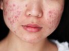 Da mặt đột nhiên nổi nhiều mụn