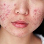 Da mặt đột nhiên nổi nhiều mụn
