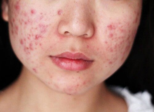 Da mặt đột nhiên nổi nhiều mụn