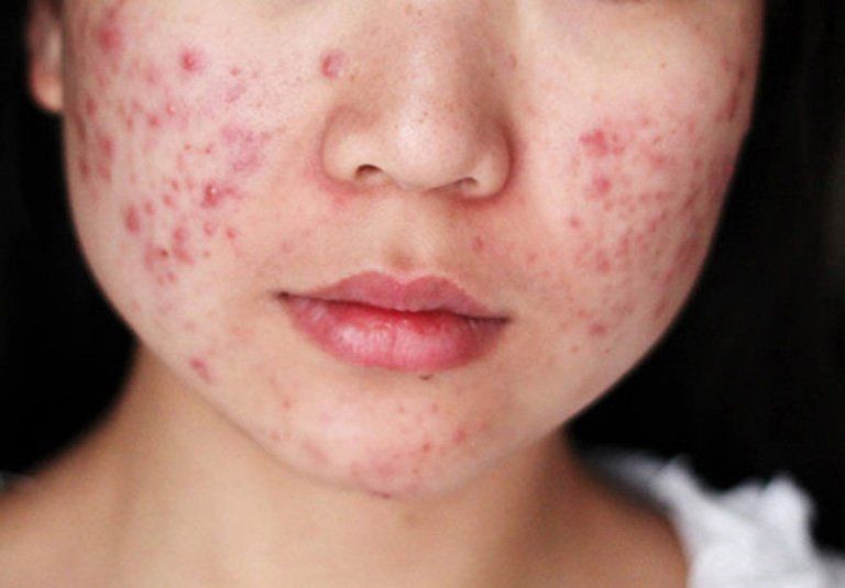 Da mặt đột nhiên nổi nhiều mụn