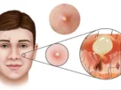 Mụn viêm bao lâu thì hết