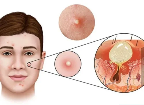 Mụn viêm bao lâu thì hết