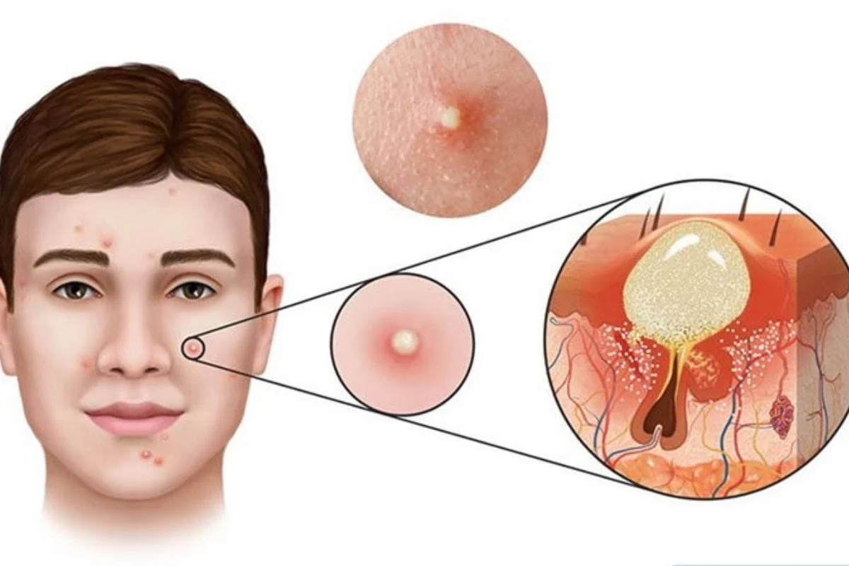 Mụn viêm bao lâu thì hết